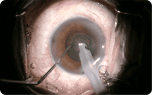 Mics Incision Cataract Surgery Bangalore - FLACS Bladeless, MICS, Phaco