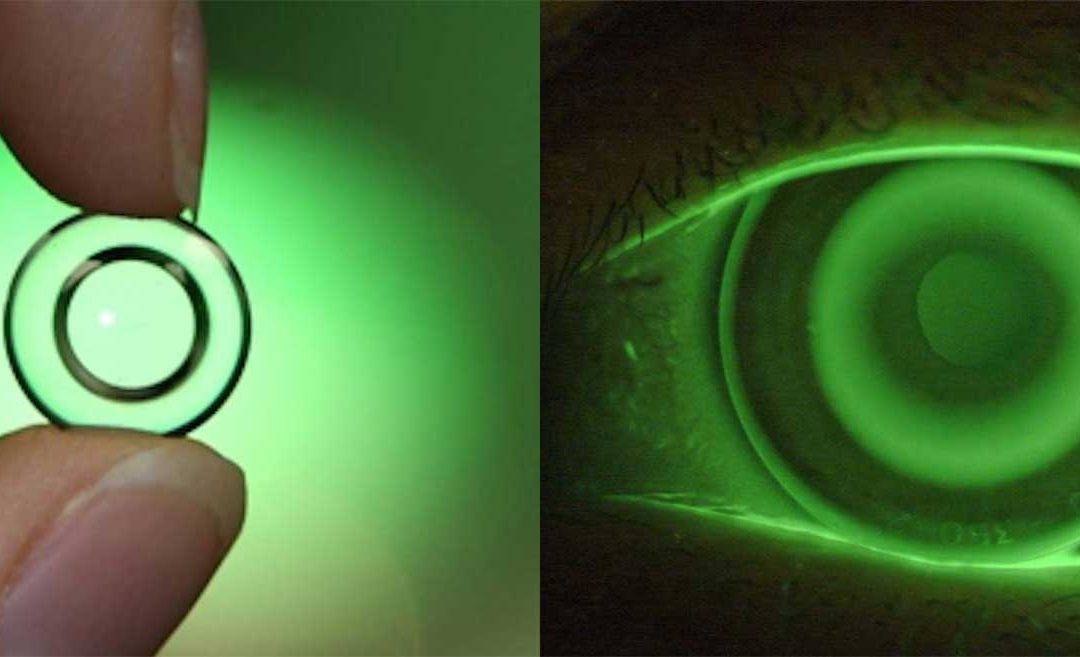 Orthokeratology Lenses – A Comprehensive Guide to Overnight Vision Correction