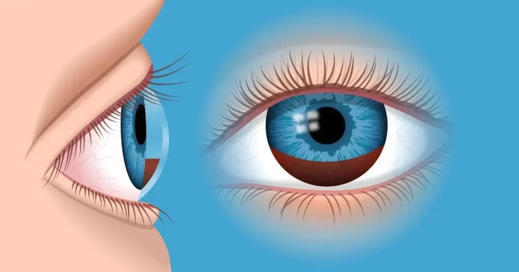 Effects of Hemophilia on the Eyes