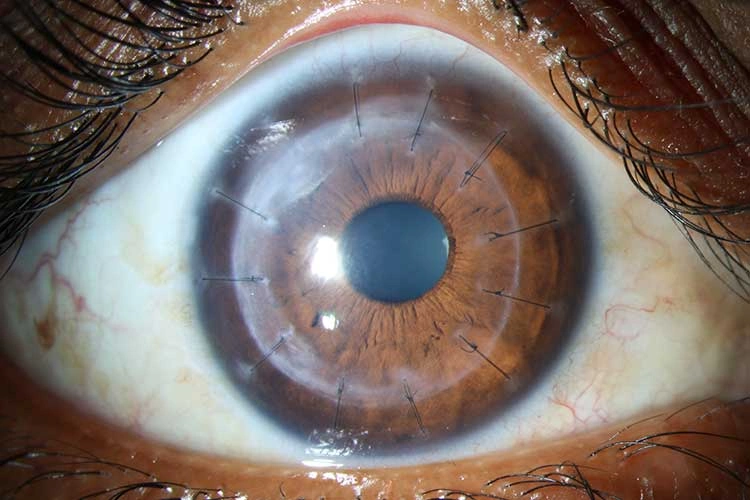 Post op - Optical penetrating keratoplasty
