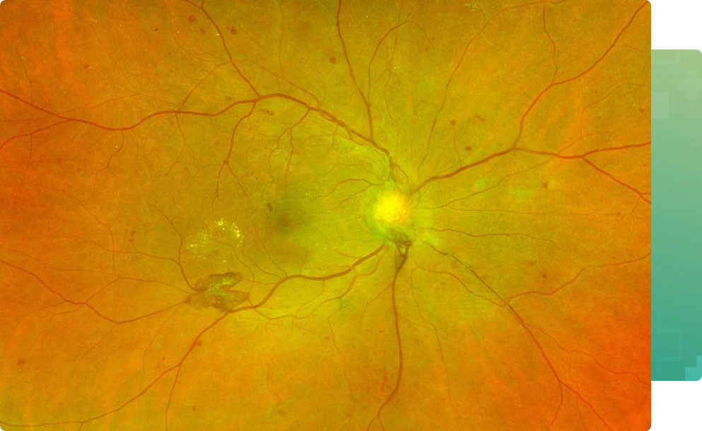 Retinoblastoma treatment