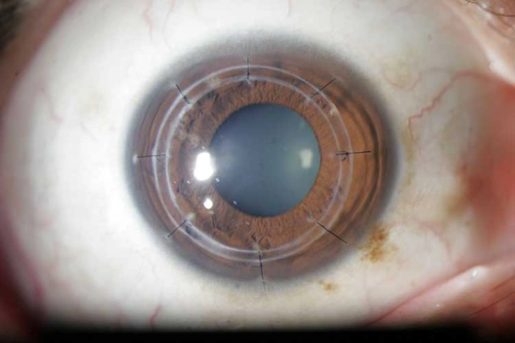 Femtosecond Laser Assisted Keratoplasty FALK