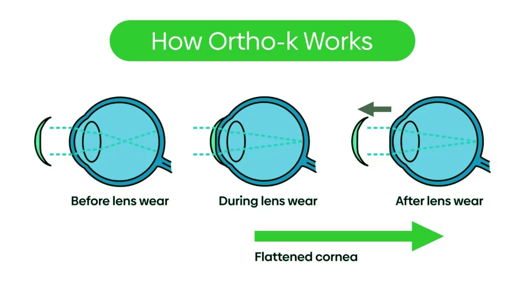 How Orthokeratology Works