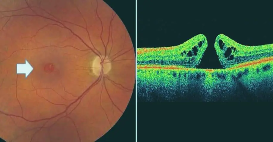 Macular Hole