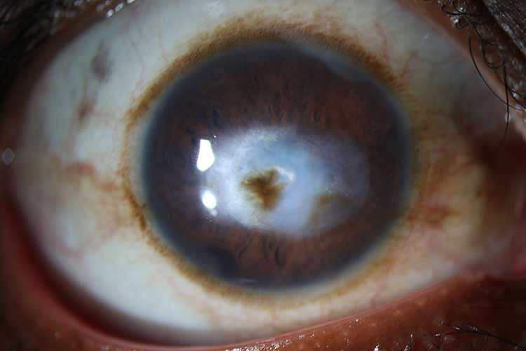 Optical-penetrating-keratoplasty-Pre-Op