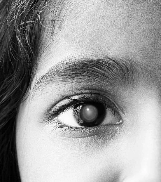 Childhood cataracts