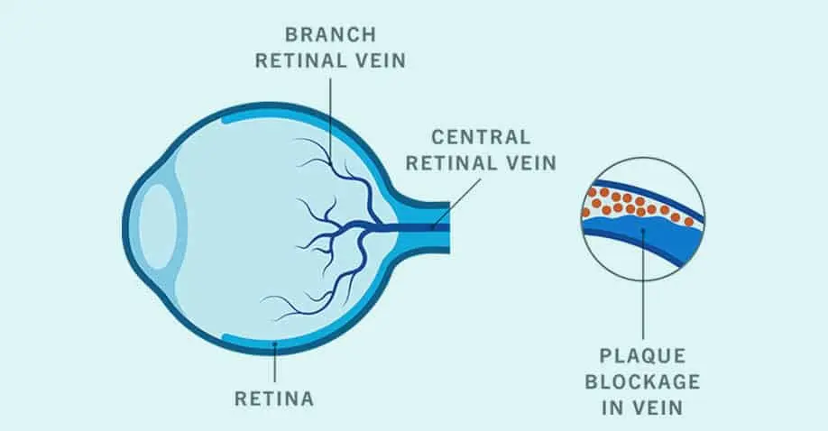 Retinal Vascular Occlusion