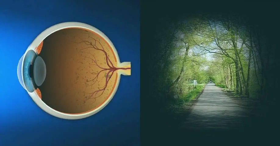 Retinitis Pigmentosa