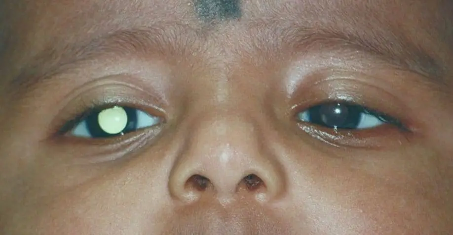 Retinoblastoma