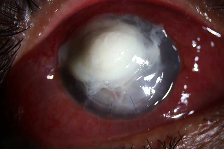 Therapeutic Penetrating Keratoplasty