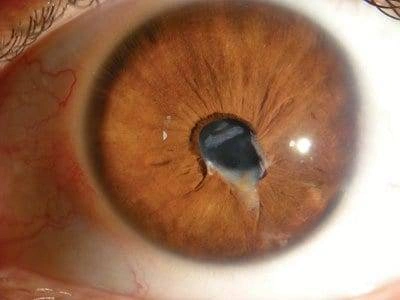 Traumatic Cataract Pediatric