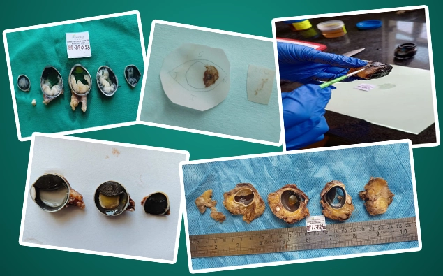 COPE at Narayana Nethralaya