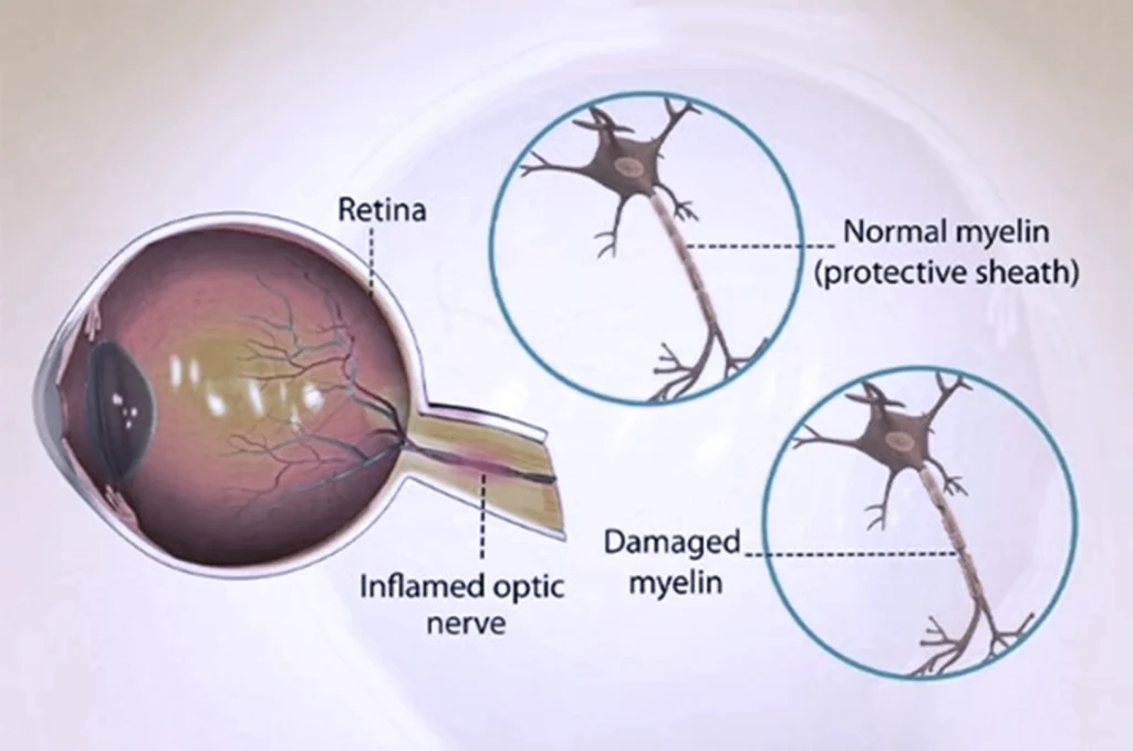Optic Neuropathies