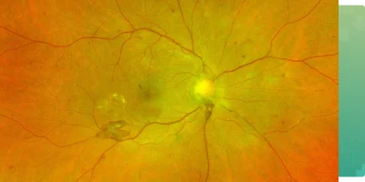 Retinoblastoma treatment