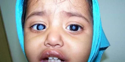Pediatric Cataract